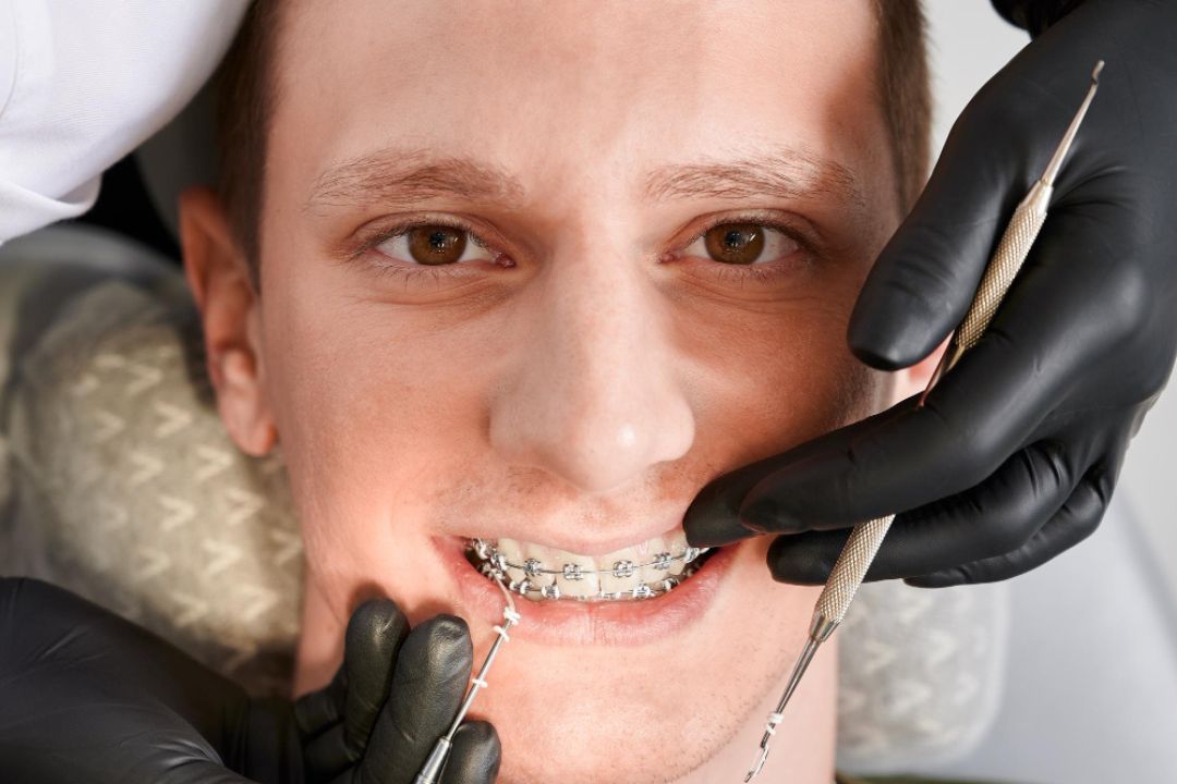 hidden benefits of dental braces most people don t know